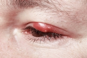 Man bør vente med kontaktlinser til en blepharitis ulcerosa infeksjon er over.
